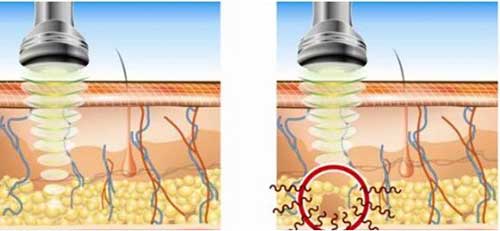 sóng siêu âm tác dụng kháng viêm tại mô dưới da